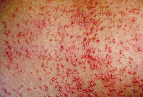 Calm down! It's heat rash.