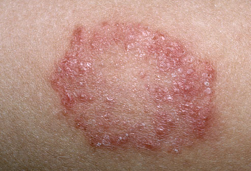 Ringworm. Which is not a worm. It's a fungus. 🍄