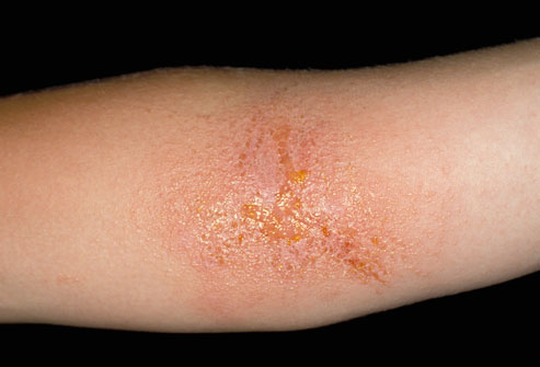 Dermatitis. They touched something. Dont touch it again. 👐