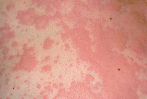 Hives. Like dermatitis and eczema, it's an allergy, but potentially more severe. Look out for wheezing 🚑