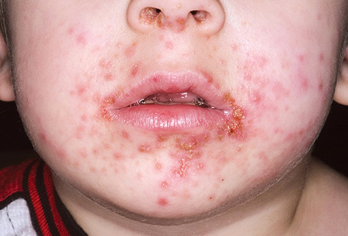 Impetigo. Your kid's not gonna die die but you should take them to the doctor. And don't let them touch stuff. And dont touch them. 🙅♀️